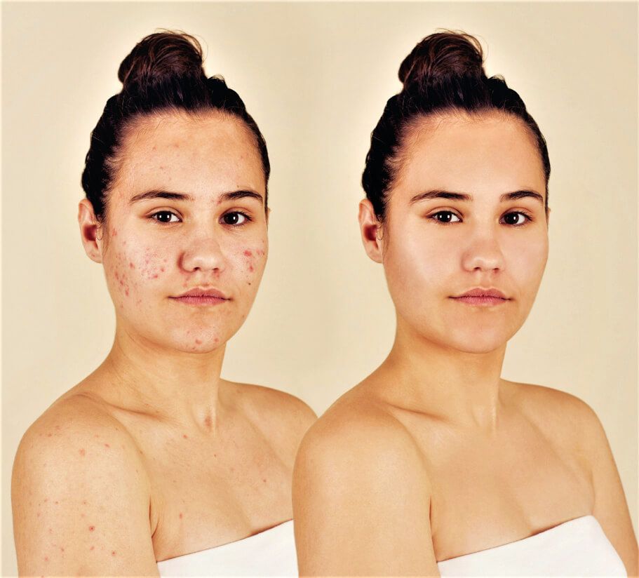 acne - Cannaisseur Brands: Best CBD Skin Care Company for Wellness